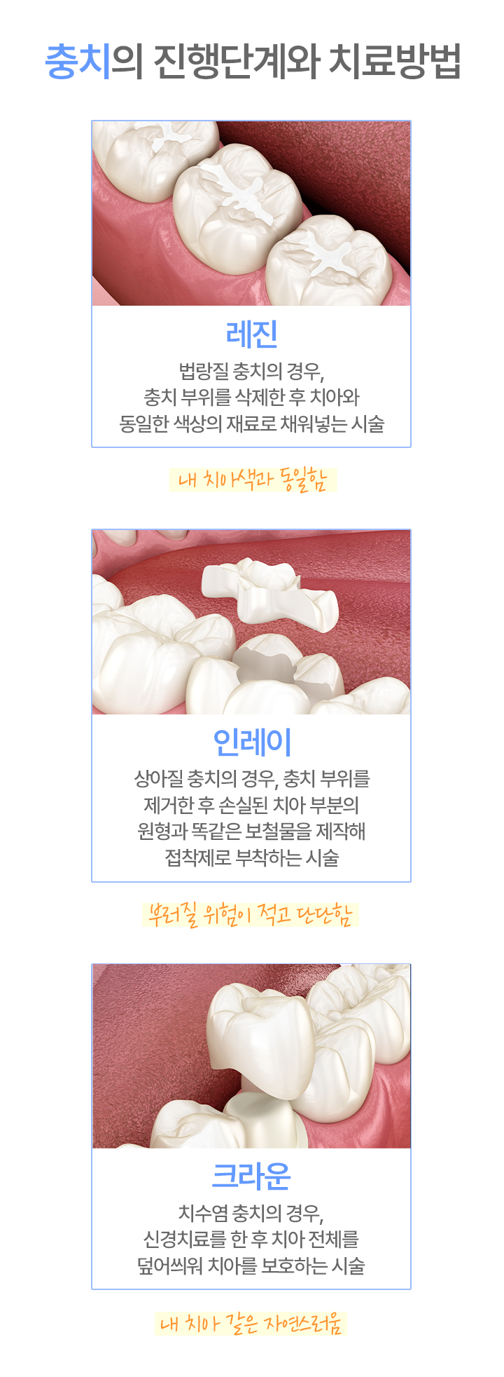 자연치아 보존치료(치료방법)